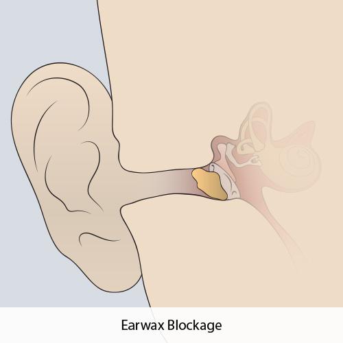 Earwax Blockage illustration